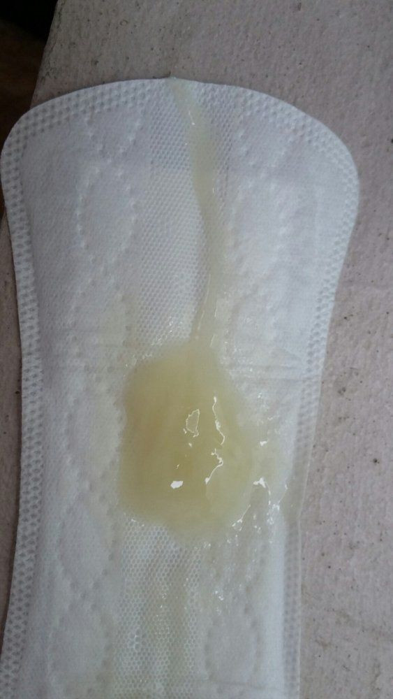 Hình ảnh chất nhầy cổ tử cung bong ra trước ngày sinh