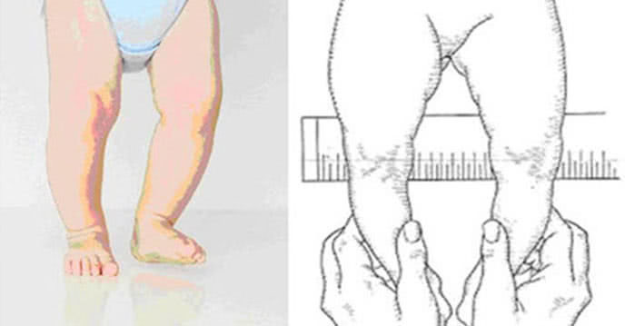 Mẹo giúp bé hết chân vòng kiềng đi đẹp như người mẫu